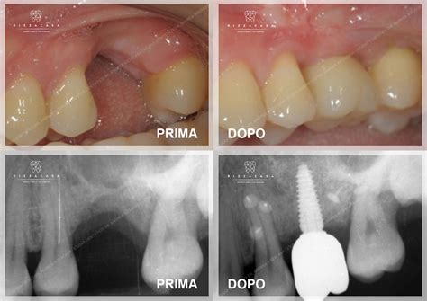 Schema di rigenerazione ossea guidata (GBR)