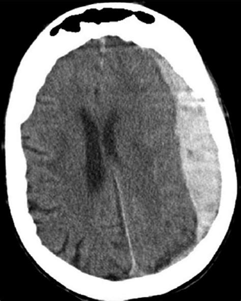 Diagramma che illustra la posizione degli ematomi epidurale, subdurale e intracerebrale