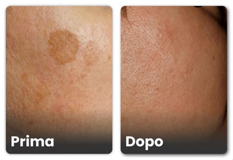 Schermata che mostra un volto con macchie scure prima e dopo l'applicazione di una crema solare