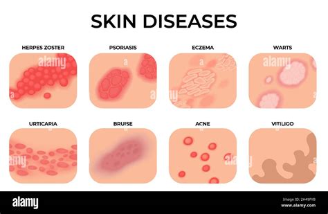 Illustrazione della pelle con chiazze di psoriasi