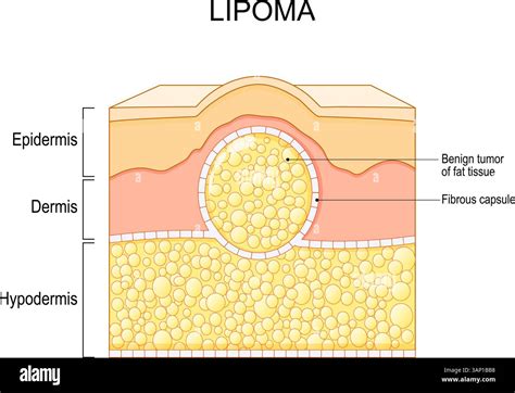 Illustrazione di un lipoma sottocutaneo