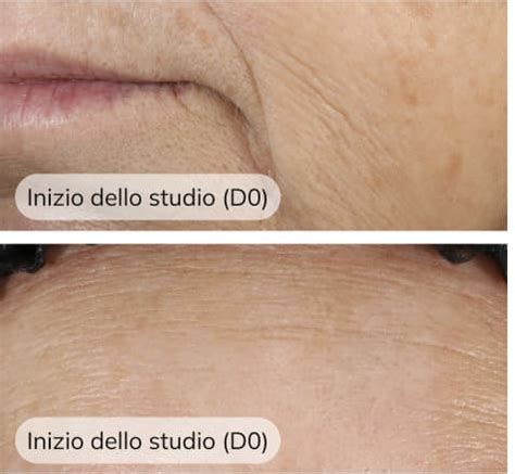 Immagine comparativa di pelle prima e dopo l'uso del retinolo