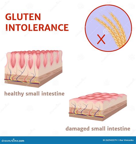 Schema degli effetti del glutine sull'intestino