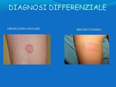 Immagine di lesioni cutanee tipiche della pitiriasi versicolor